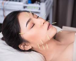 Akupunktur Behandlung